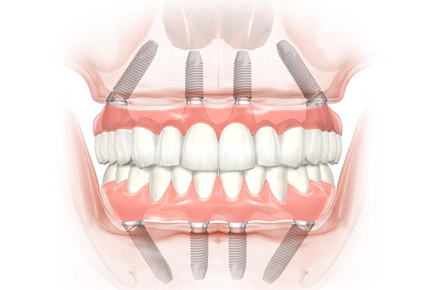 Infection Control in Dentistry