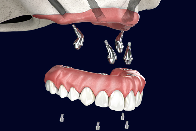 Infection Control in Dentistry